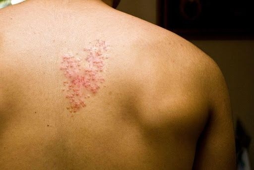 زونا چیست، علائم و هرآنچه باید بدانید