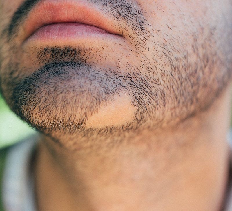 علت ابتلا به کچلی ریش و درمان آن چیست؟
